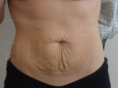 Before-Tummy Tuck