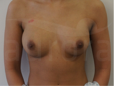 Before-Removal and replacement of implants