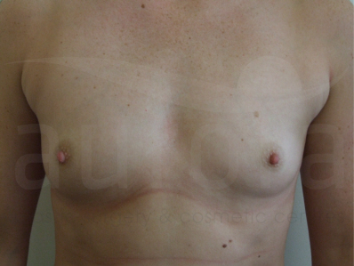 Before-Breast Enlargement