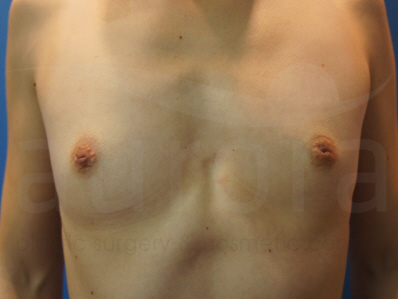 Before-Breast Enlargement