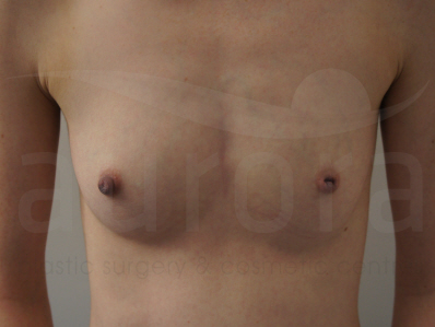 Before-Breast Enlargement