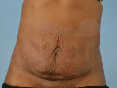 Before-Tummy Tuck