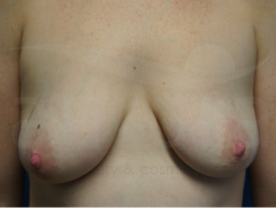 Before-OCEAN Breast Enlargement