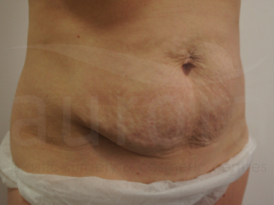 Before-Tummy TUck