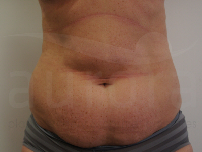 Before-Tummy Tuck