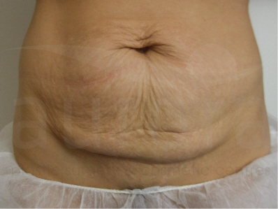 Before-Tummy Tuck