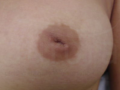 Before-Inverted nipple