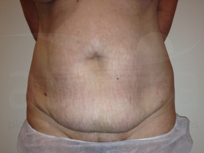 Before-Tummy Tuck