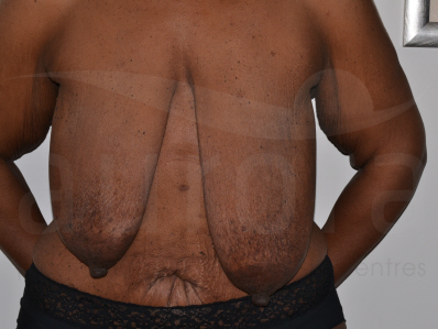 Before-Breast uplift