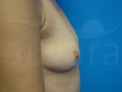 Before-Breast Enlargement