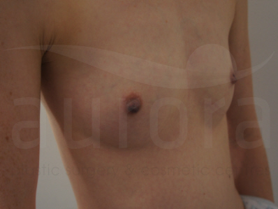 Before-Breast Enlargement