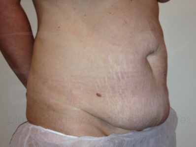 Before-Tummy Tuck