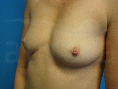 Before-Breast Enlargement