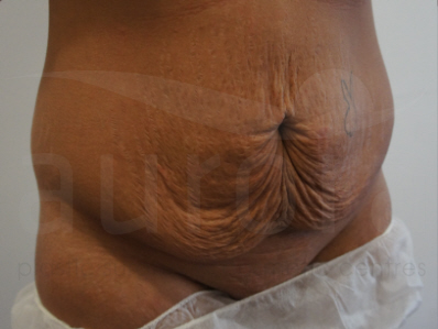 Before-Tummy Tuck