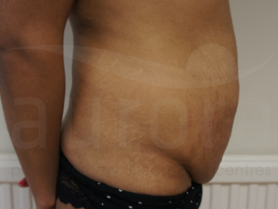 Before-Tummy TUck