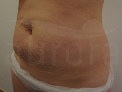 Before-Tummy Tuck