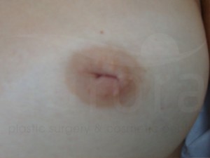 Inverted nipple before photo 5 Aurora Clinic