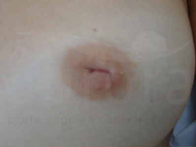 Before-Inverted nipple