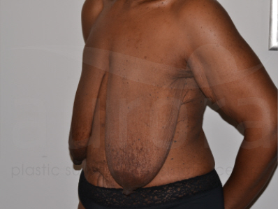 Before-Breast uplift