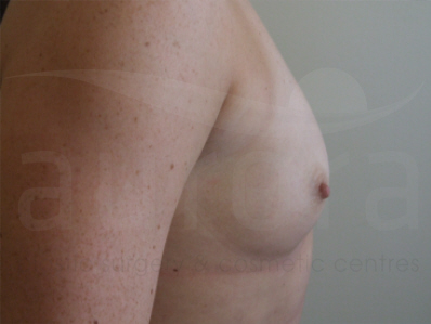 Before-Breast Enlargement