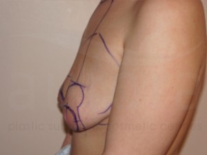 Our latest before and after photos of Breast Enlargement with Uplift Surgery