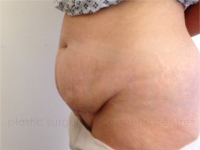 Before-Tummy Tuck