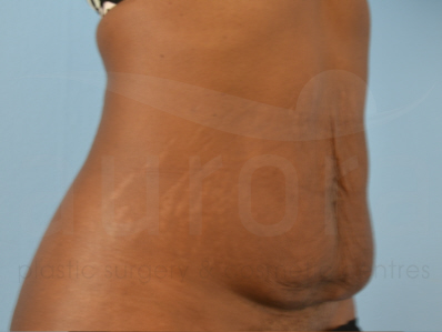 Before-Tummy Tuck