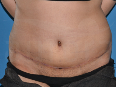 After-Tummy Tuck