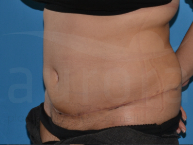 After-Tummy Tuck