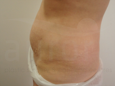 Before-Tummy Tuck