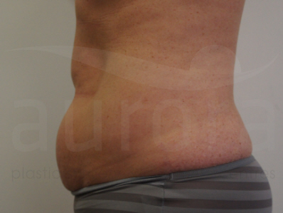 Before-Tummy Tuck