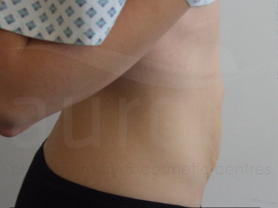 Before-Tummy Tuck