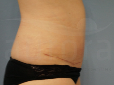 After-Tummy Tuck