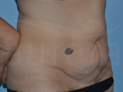 Before-Tummy Tuck