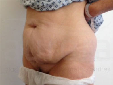 Before-Tummy Tuck