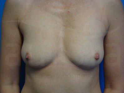 Before-Breast Enlargement