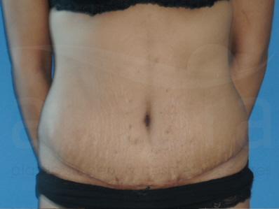 After-Tummy Tuck