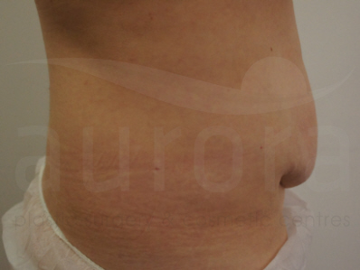 Before-Tummy Tuck