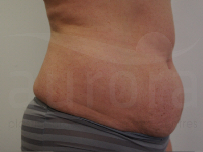 Before-Tummy Tuck