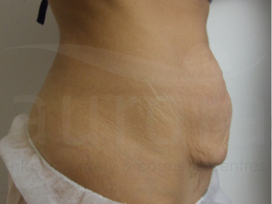 Before-Tummy Tuck