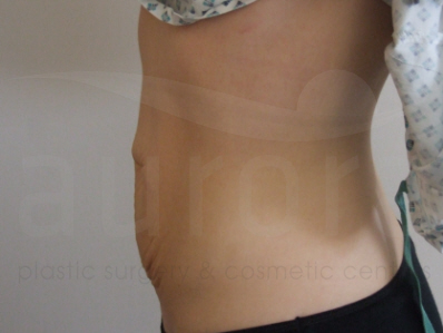 Before-Tummy Tuck