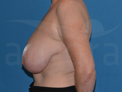 Before-Breast Reduction