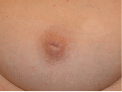 Before-Inverted nipple