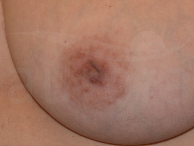 Before-Inverted nipple