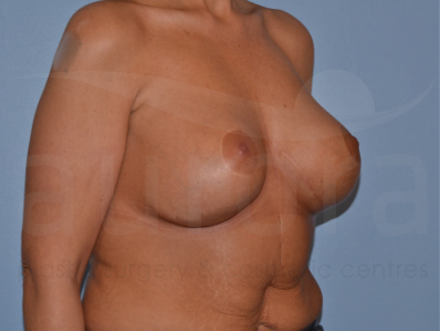 Before-Removal and replacement of implants