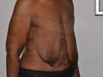 Before-Breast uplift