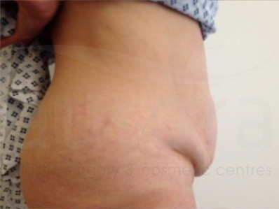 Before-Tummy Tuck