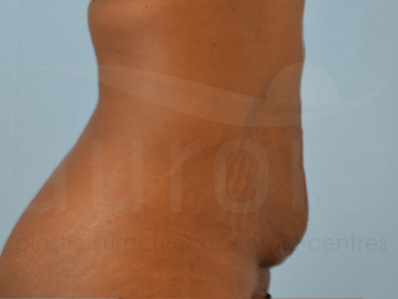 Before-Tummy Tuck