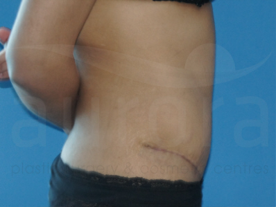 After-Tummy TUck
