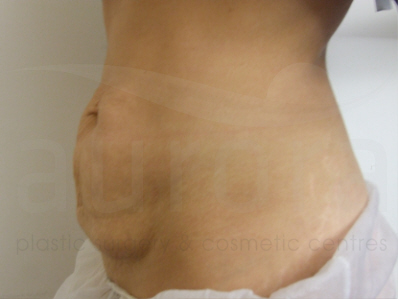 Before-Tummy Tuck